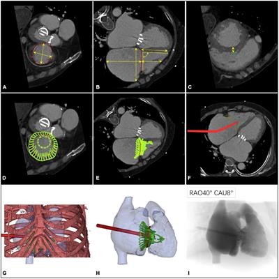 Safety, efficacy, and clinical outcomes of transcatheter tricuspid valve replacement: One-year follow-up
